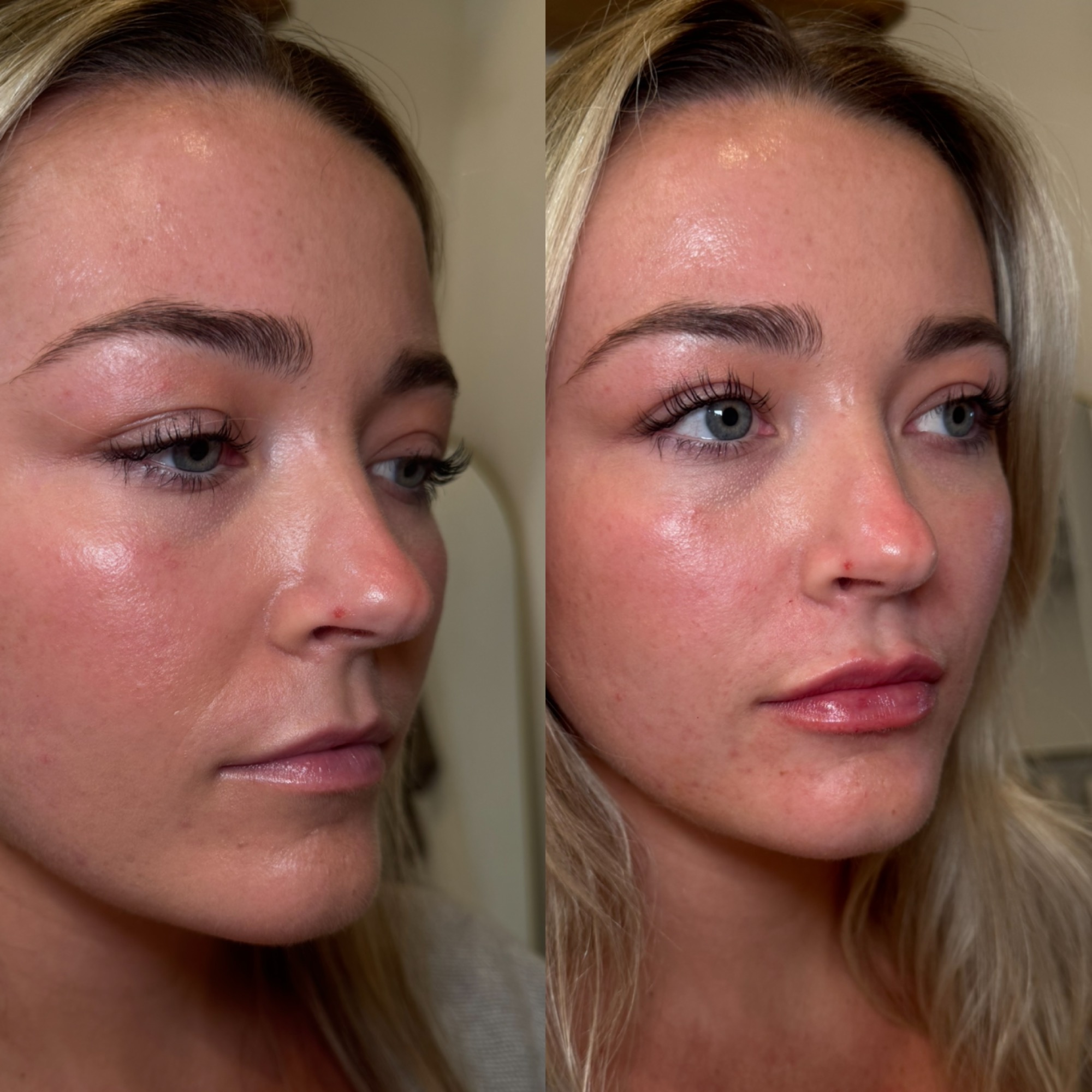 Lip filler before and after — side profile, Clearwater FL