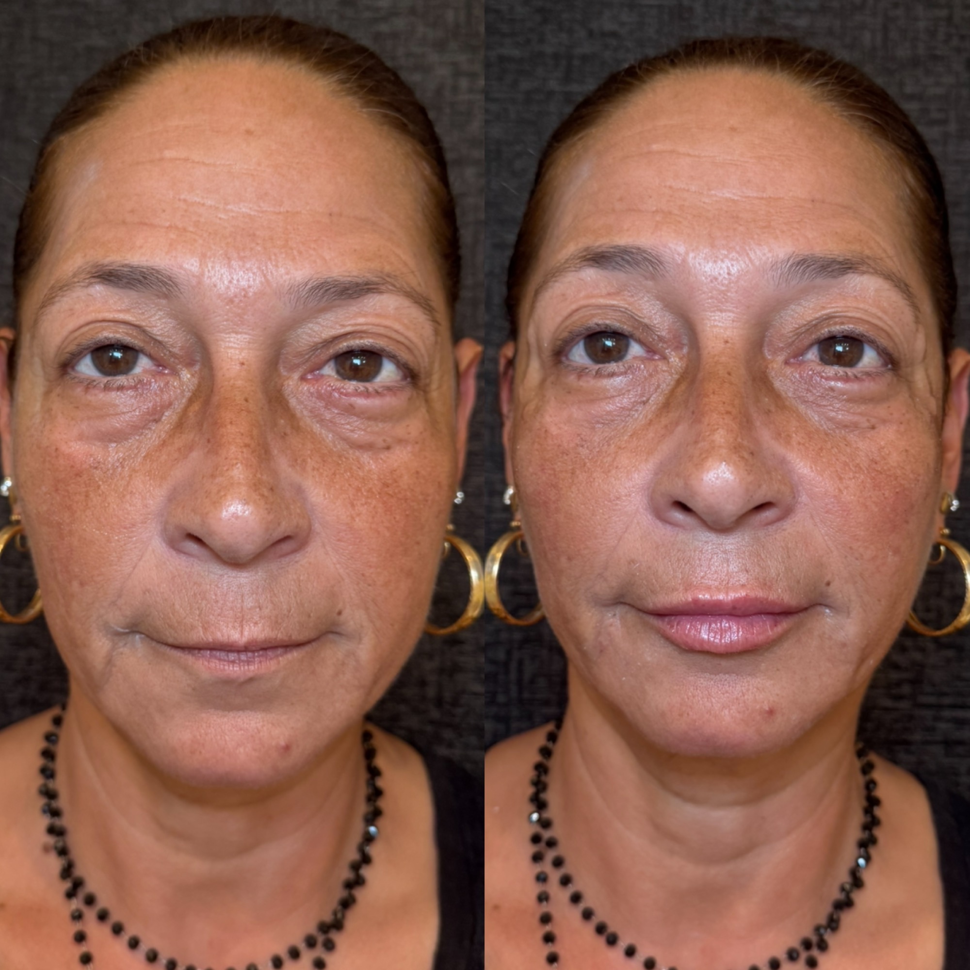 Lip filler & facial rejuvenation before and after — Clearwater FL
