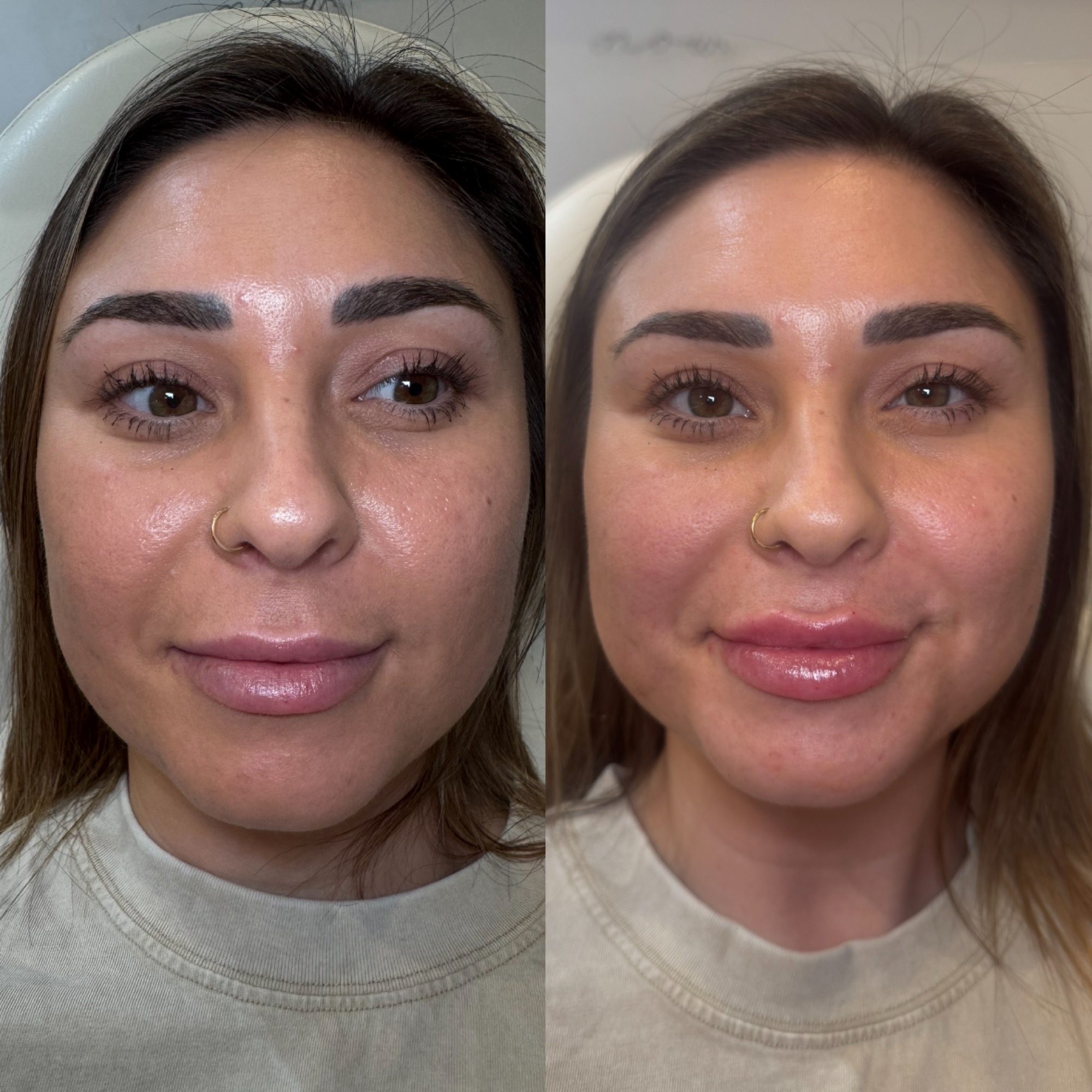 Lip filler before and after — defined shape, Clearwater FL