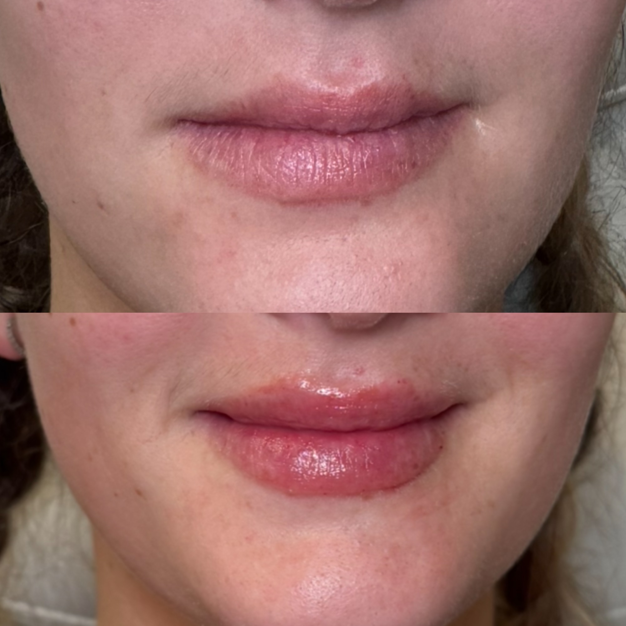Lip filler before and after — soft hydrated lips, Clearwater FL