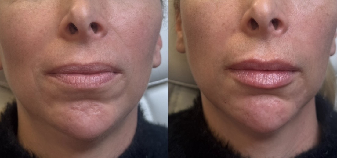 Lip and chin filler before and after — front view, Clearwater FL