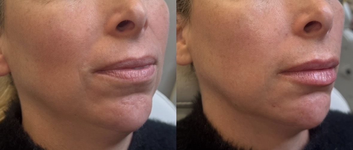 Lip and chin filler before and after — side angle, Clearwater FL