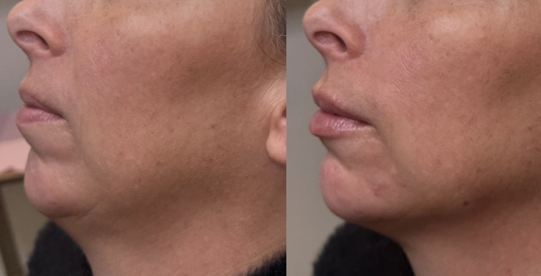 Lip and chin enhancement before and after — refined side profile, Clearwater FL