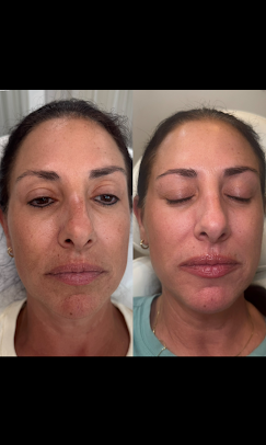 Skin Rejuvenation before and after at Eternal Beauty Lifestyle Clearwater Spa