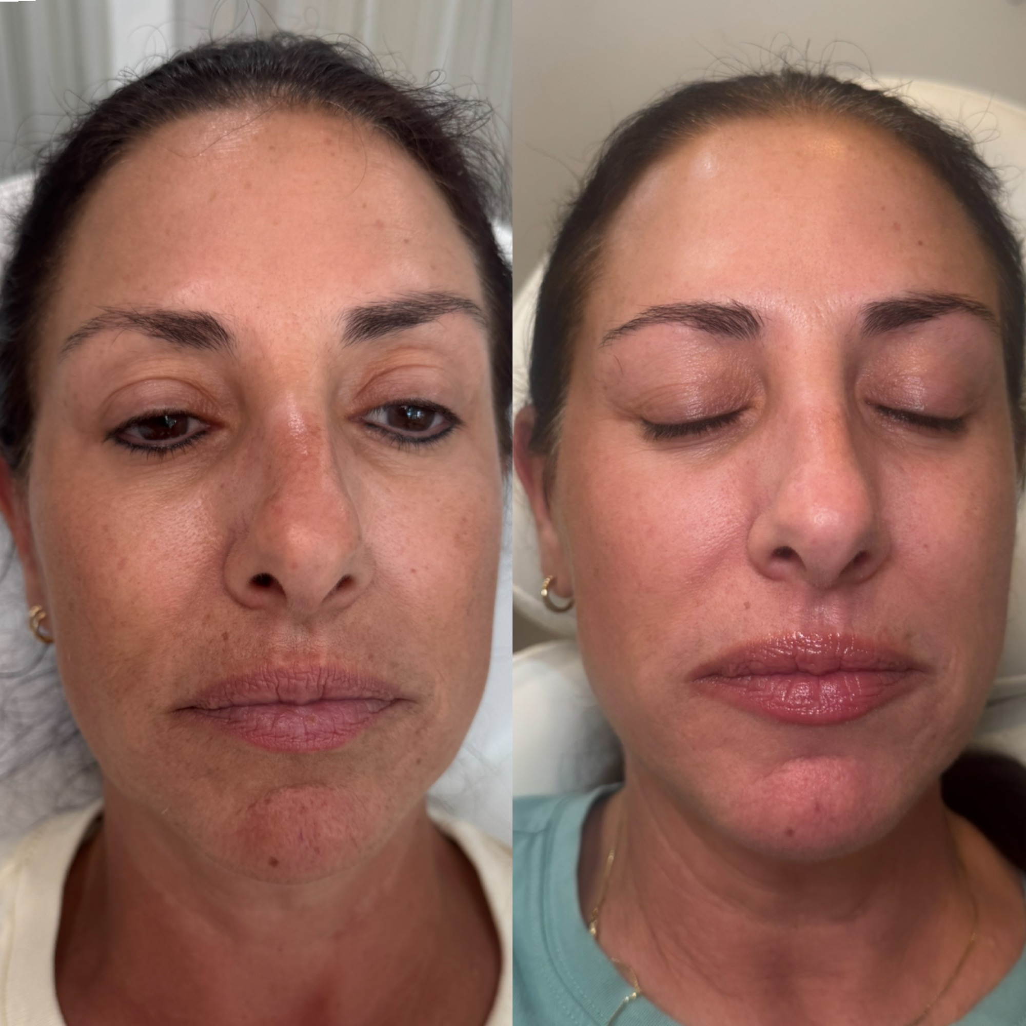 Microneedling for Clearwater Beach FL patients